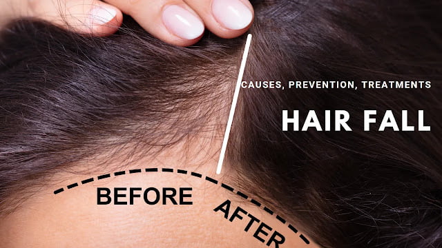 Hair Fall: Causes, Prevention, and Treatments In 2023